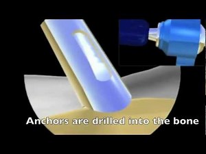 shoulder dislocation surgery, labral repair, bankart repair