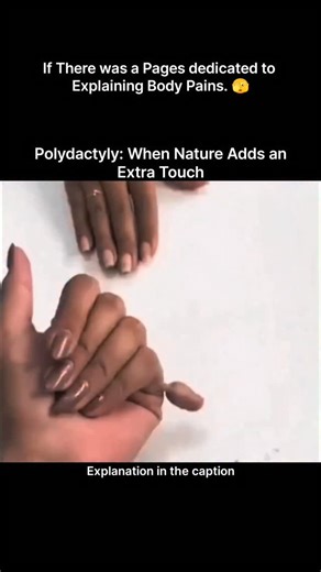 Explaining Human Pains | Polydactyly is a fascinating example of how genetics can create natural variations in the human body. It is a congenital condition where a... | Instagram