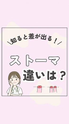 いーちゃん ￤ 外科で使える看護知識 on Instagram: "まとめた資料が欲しい人は以下を見てね〜⭐️ ①わたしをフォロー ②コメント欄で 「ストマ」か「人工肛門」って ってコメントしてね！💩 ※フォローしてないと資料届きません💦 ストーマについて解説のリクエストいただきました！ 第三段3️⃣ 以下に解説しきれなかったところ解説いたします🔽 もっと勉強したい人は見て⭐️ 係蹄式ストマ・二連銃ストマは見ただけでは どちらが排泄口かわからないから、 排泄口と粘液漏は医師に確認したり、 実際に排便が出てくるほうを排泄口と見極めよう👀 排泄口付近は便が付着しやすいから 位置を把握することで注意してケアができるよ！ 聞きたいことあったらDMしてね✉️ _______________________________ 外科ナースのいーちゃんです👩‍⚕️ 忙しい病棟看護師さん💉 毎日バタバタで、 わからないことがあっても調べる余裕なし…💦 仕事終わりはクタクタで、 勉強する気力もない…😣 でも、大丈夫！✨ ここを1日1分見るだけで、仕事の自信UP⤴️ スキマ時間にサクッと学んで