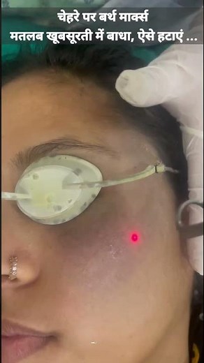 Black birthmark removal by laser technology.Call 9990804085