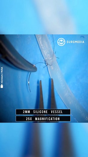 World’s First Clinically Available Microsurgical Robotic System. Microsure’s MUSA facilitates lymph node surgery and reconstruction of lymphatic vessels as small as 0.3 mm in diameter. It scales down movements and filters out tremors to increase precision in this delicate super microsurgical procedure, as well as decreasing the challenge and complexity of these types of interventions dramatically. The surgeon controls the system via joysticks while working in an ergonomically comfortable positio