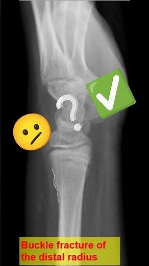 Buckle fracture of the distal radius