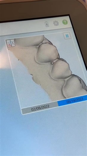 “I thought my gums were gone for good. Every time I brushed, they bled and pulled back a little more. My dentist told me to ‘be gentler,’ but nothing changed — until I tried the Selene NanoBrush. Within two weeks, the bleeding stopped. A month later, my gums looked pink, healthy, and full again. I can finally brush without pain — it honestly saved my smile.” 🦷 Thousands are seeing the same results. The NanoBrush doesn’t just clean — it helps your gums heal. | SeleneTeeth