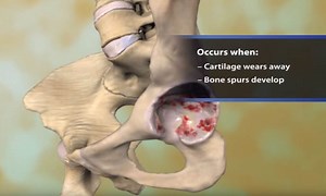Osteoarthritis of the Hip Animation - OrthoInfo - AAOS