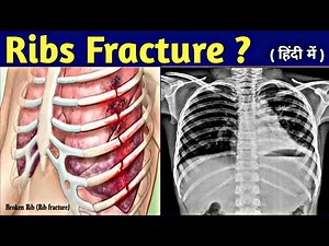 How to read Ribs Fracture on Chest X-ray | How to Count Ribs | Ribs Fracture X-ray | UdayXray