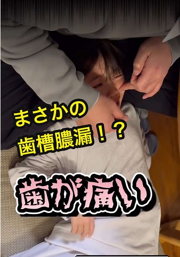 反対咬合（受け口）治療中のその後の経過その②リンガルアーチを外して1カ月後に全体矯正にしたら磨き残しが凄くて歯からまさかの😨😨😨#反対咬合#小学生 #治療 #歯科 #歯磨き