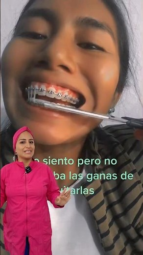 The importance of intermaxillary elastics 🤓#ligas #intermaxillaryligas #orthodontics