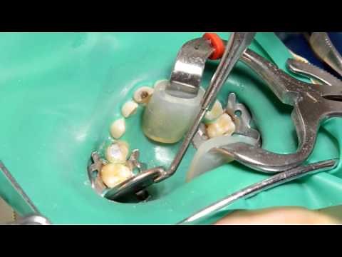 Restoring an upper primary molar with a SSC, voiceover, US