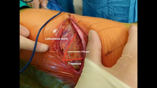 M - Muscle-sparing thoracotomy: Anatomy and technique