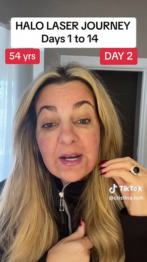 Halo Laser Treatment Journey: Before & After 2 Week Progress