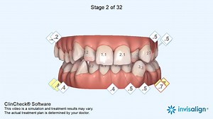 ClinCheck Software enables us to customize your Invisalign treatment and helps ensure every tooth moves in the right order and on the right time. Dentacare Philippines with our Chief Dentist Dr. Joanna Cristi is your Invisalign Certified Provider. Message us today to book your Invisalign consultation. | Dentacare Philippines | Facebook