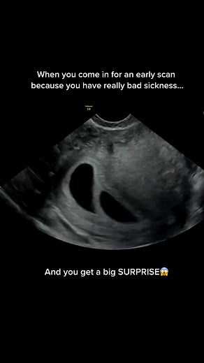 Early Pregnancy Scan for Multiple Babies