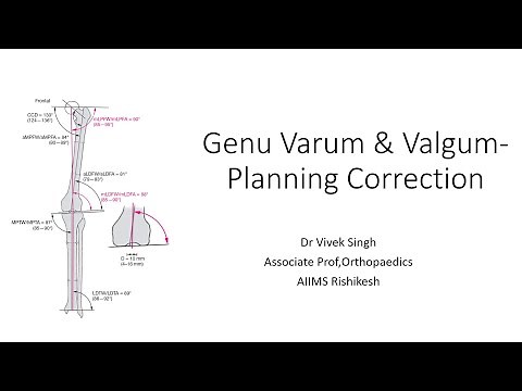 Singh's Ortho Insights-Genu varum & valgum-Planning correction