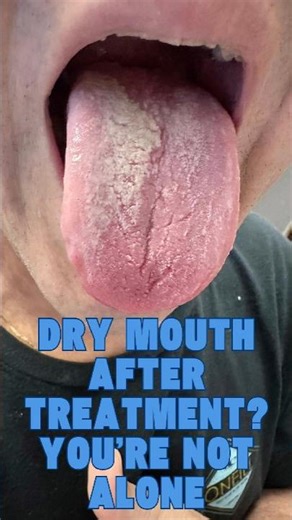 Dry Mouth After Treatment? You’re Not Alone
