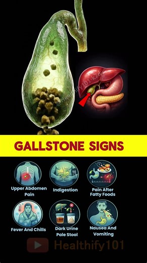 6 Gallbladder Stone Symptoms You Should Never Ignore | Gallstone Signs