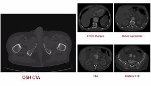 Case Presentation and Discussion: Endoleak Embolization