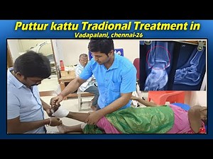 Puttur kattu a tradional treatment in Vadapalani,chennai Dr.R.S.Velumani