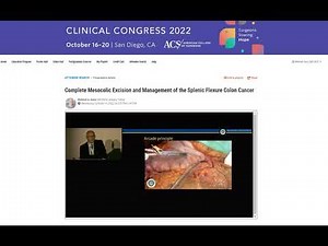 Complete Mesocolic Excision and Management of the Splenic Flexure Colon Cancer