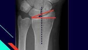 Distal radius fractures parameters part 2 Radial inclination