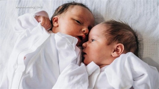 Meet twins born from '1 in a million' pregnancy