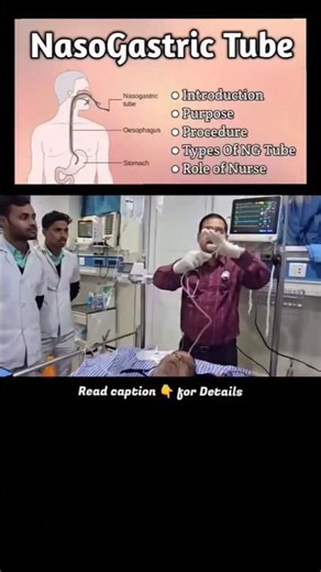🩺 Naso-Gastric (NG) Tube Insertion & Feeding Procedure #nasogastric #feeding