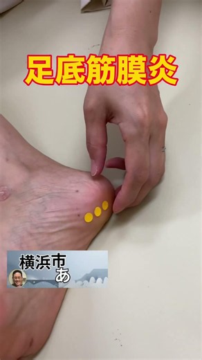 足底筋膜炎