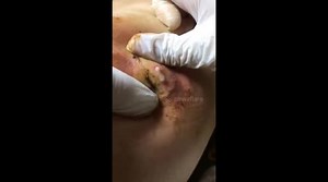 Remove a 7-years-old pimple from the woman's thigh