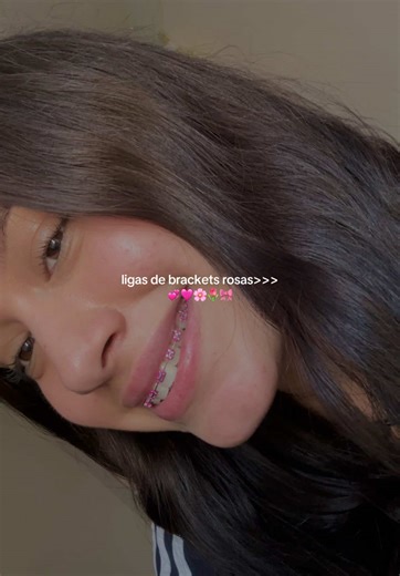 Ortodoncia: Colores y Tipos de Ligas para Brackets