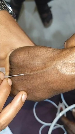 IV Cannulation Technique Procedure Video