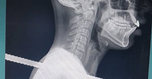 கழுத்தை துளைத்த கம்பி... 4 மணி நேரம் ஆபரேஷன்..!- வாலிபருக்கு உயிர் கொடுத்த மதுரை அரசு மருத்துவர்கள்