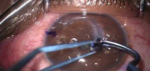 Corneal Allogenic Intrastromal Ring Segment - Eyetube