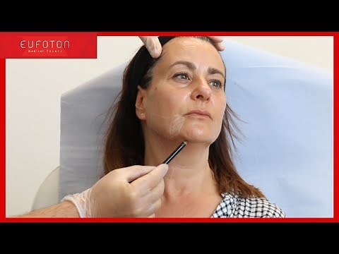 Endolift® Webinar Live | Dr Ghanem & Dr Verma [Eufoton®]