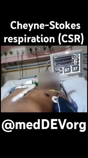 Cheyne-Stokes respiration #youtube #shorts #trending #medico ‪@medDEVorg‬