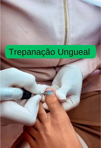 // TREPANAÇÃO UNGUEAL // #podologia #videoviral #video #unhas #incrivel