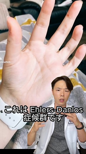 エーラスダンロス症候群の特徴と診断