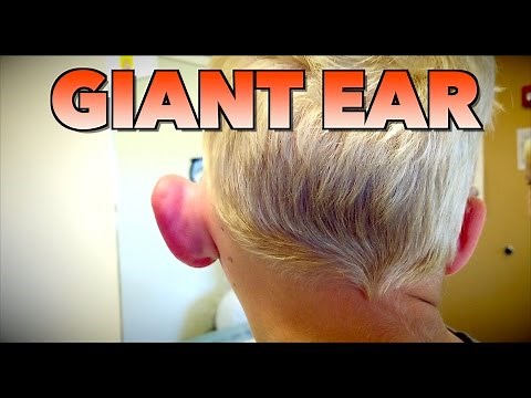 GIANT EAR: Allergic Reaction or Infection? | Dr. Paul