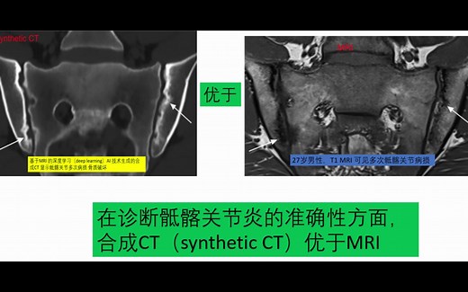 用AI技术从核磁共振（MRI）合成CT，诊断骨侵蚀破坏的效果居然优于MRI，显示细节方面等同普通CT，简直是影像学的chatGPT, 将来就不用专门做普通CT了