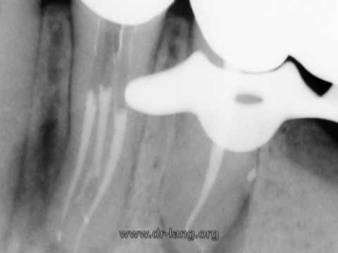 Endodontic treatment: lower premolar with 3 roots