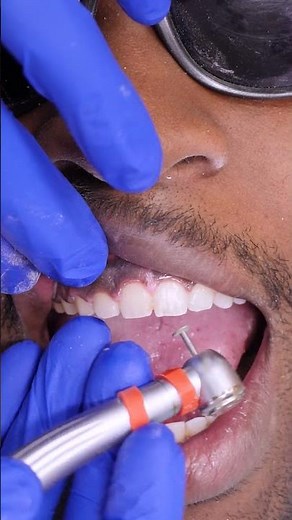 How Tooth Shaving Works