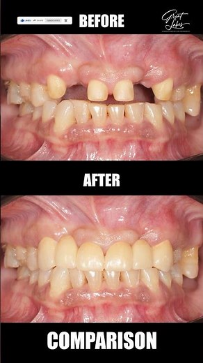 Dental Bridge Procedure | Treatment of Missing Front Teeth | Fixed Artificial Teeth - #dentalbridge