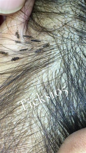 Remove lice #😱😱😱omg #🥶🥶🥶 #liceremoval #😭😭😭 #😂😂😂