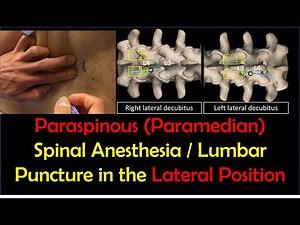 "How-To" Guide - Paraspinous Lumbar Puncture / Spinal Anesthesia [Lateral Position]