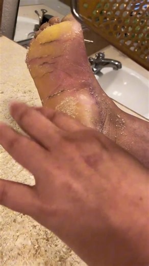 154K views · 630 reactions | Giant foot rasp wins!! Link in bio, not sponsored 殺 #parmeseanpalms #parmesanpalms #callousedfoot #callusedfoot #footcallus #footcallusremover #footcallusremoval #footcalluses #callousremoval #callousremover #amazonfinds | Fairy.freak | Facebook