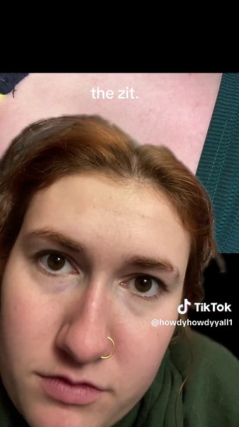 Girl's Gross Discovery on Boyfriend's Back | Pimple Popping Warning!