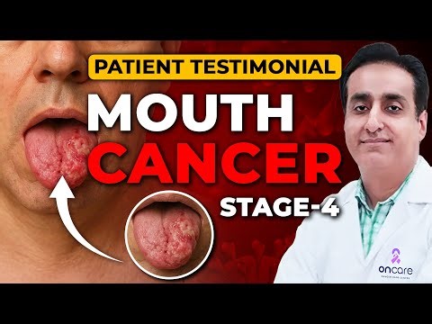 Cancer Survivor's Story Of Surviving Stage 4 Oral Cancer | Oncare cancer