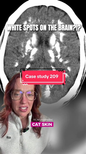 Case Study 209: Identifying White Spots in the Brain