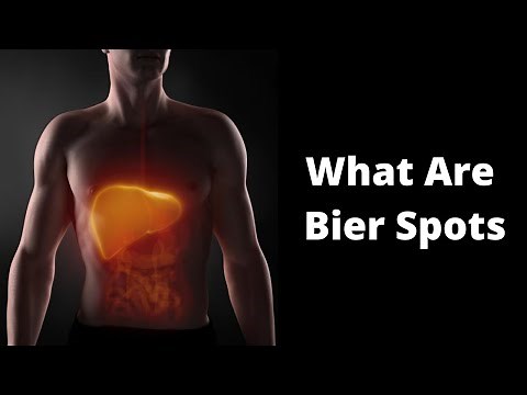 What Are Bier Spots