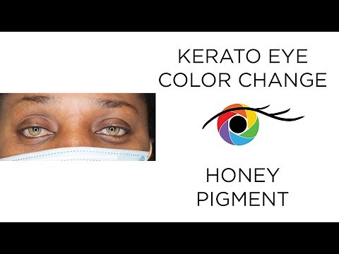Eye Color Change from Dark to Light Brown with Kerato (Honey Pigment)