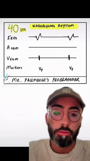 Learn about pacemakers in a 60 second video! 💪🏼❤️ Assessing a patient’s underlying rhythm is important to determine if their pacemaker is working appropriately for their specific cardiac rhythm dysfunction. This test was done at VVI 40 bpm, that means that the pacemaker will not pace the ventricle until a heart rate of 40 bpm, running the test at a rate that low allows us to see if any AV intrinsic conduction or escape beats are present. What questions do you have about pacemakers? Follow and 
