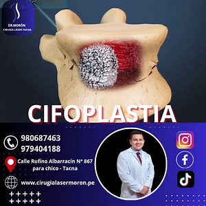 La cifoplastia es un tipo de cirugía que se realiza en la columna vertebral para reducir el dolor causado por una fractura o afección de la columna vertebral, como la osteoporosis. Varias afecciones de la columna vertebral pueden hacer que la columna se fracture y se comprima, causando dolor severo y dificultando el movimiento. Al estabilizar las fracturas con cemento, la cifoplastia tiene como objetivo aliviar el dolor, fortalecer la columna vertebral y mejorar la movilidad. 👉Tu Salud es nuest